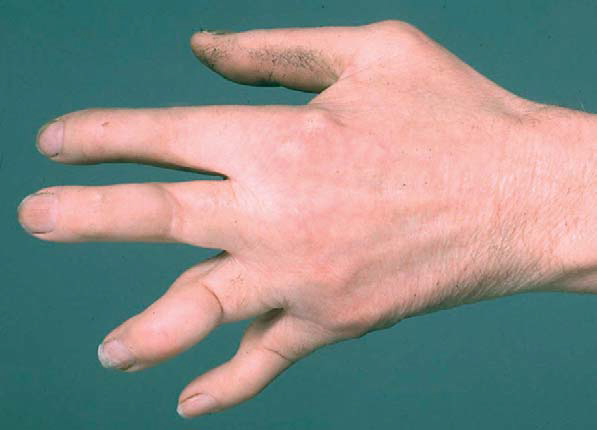 Arthrite psoriasique sur les mains