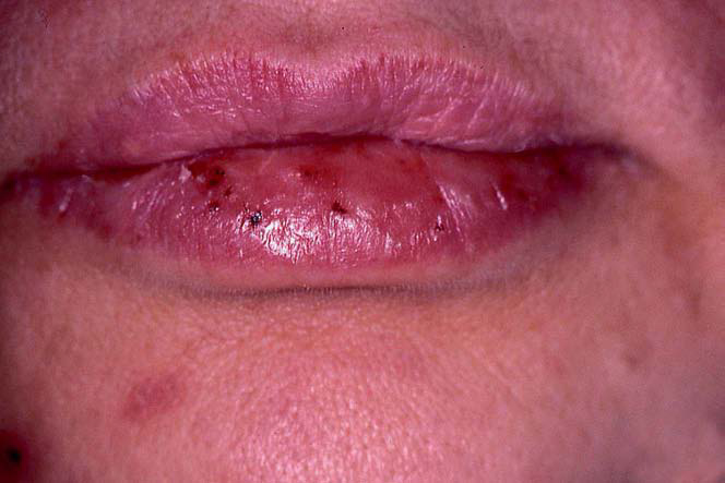 Psoriasis sur les lèvres