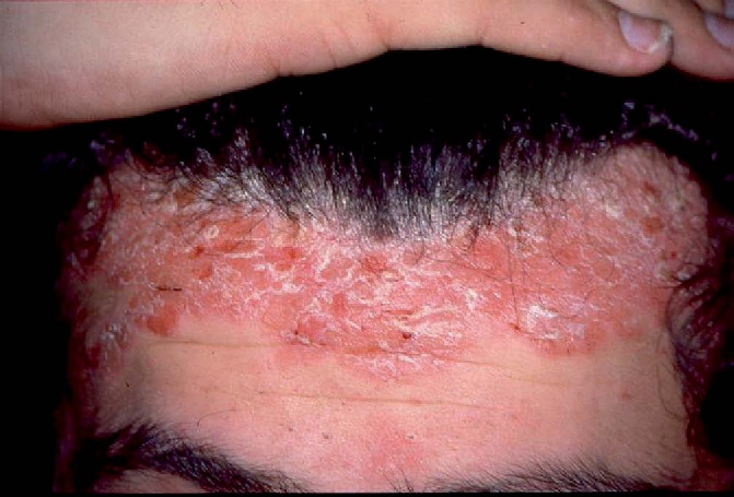 Psoriasis situé au niveau du cuir chevelu et du front