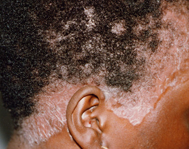 Psoriasis en plaque sur le cuir chevelu