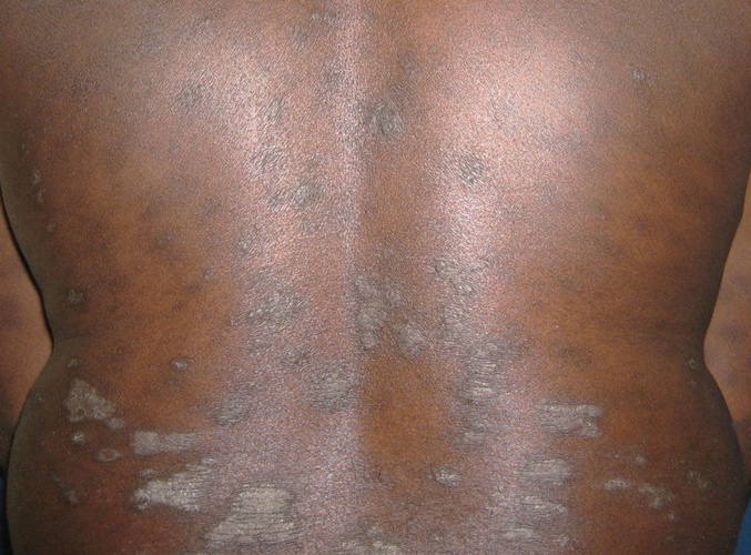 Lésions de psoriasis dans le dos