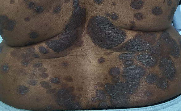 Lésions de psoriasis dans le dos d'un patient