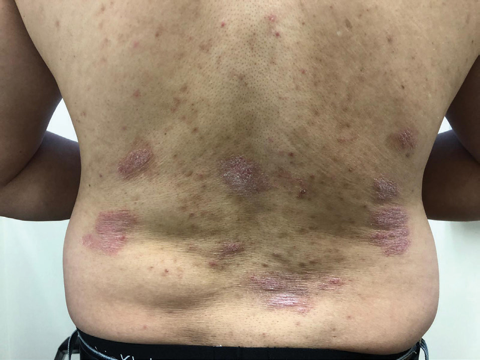 Plaques de psoriasis dans le dos