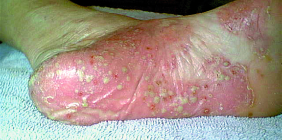 Pustules psoriasique sur le pied d'un patient