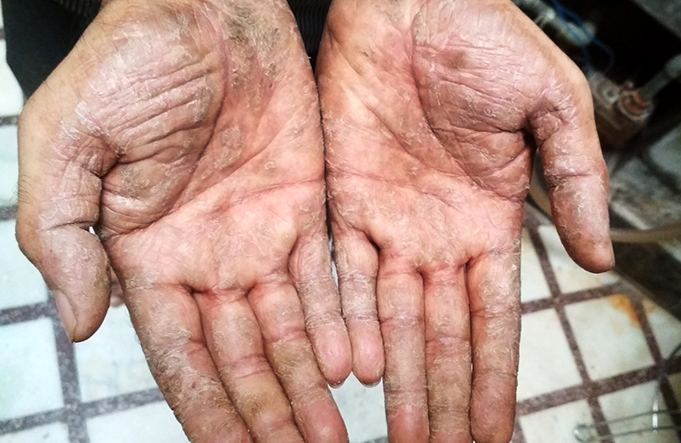 Lésions cicatrisantes de psoriasis sur les mains
