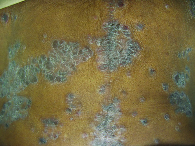 Psoriasis dans le dos d'un patient