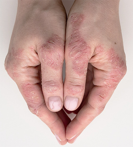 Plaques de psoriasis sur les mains