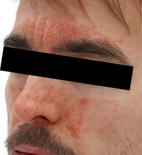 Psoriasis sur le visage d'un patient